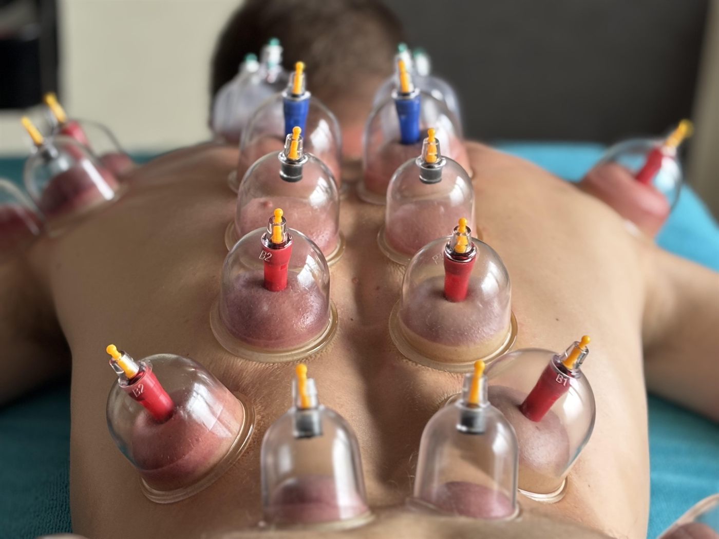 Rug van een cliënt met meerdere cups tijdens een Transformational Cupping-behandeling