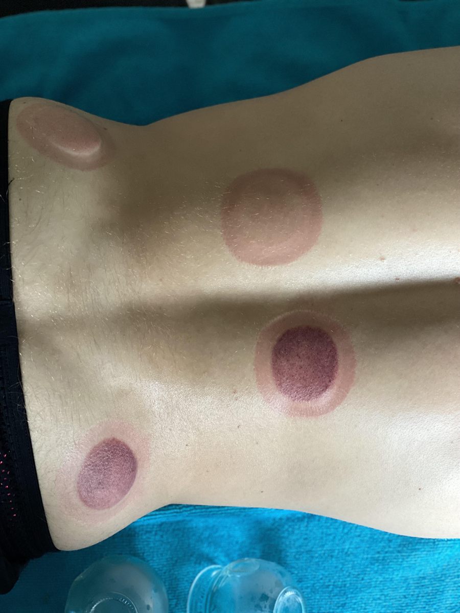 Ronde cupmarkeringen op de onderrug na een behandeling