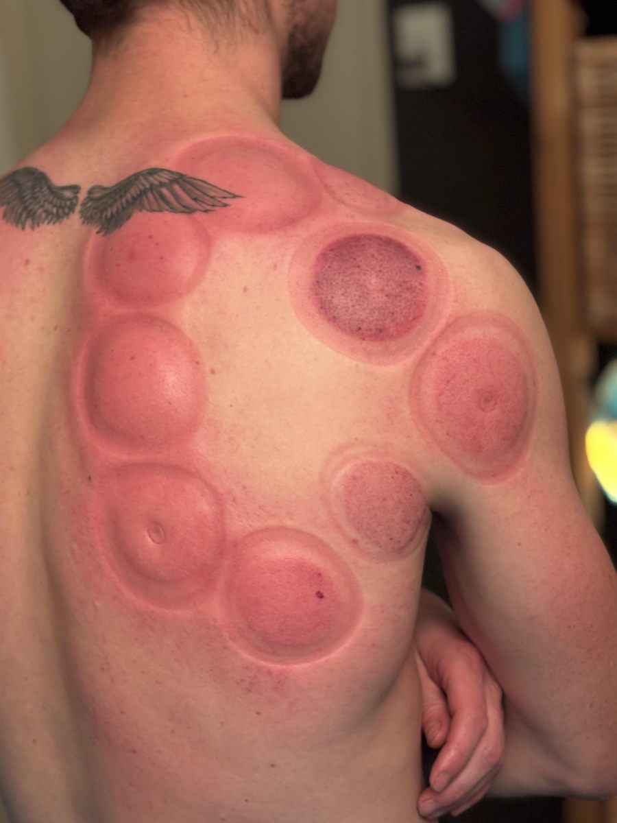 Rug en schouder van een cliënt met ronde verkleuringen na een cuppingbehandeling